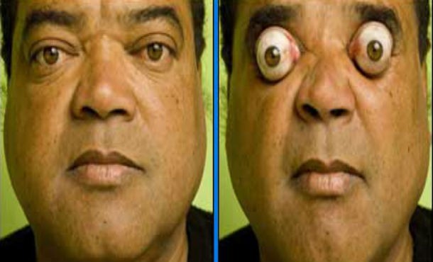 Man who can pop his eyes Claudio Pinto